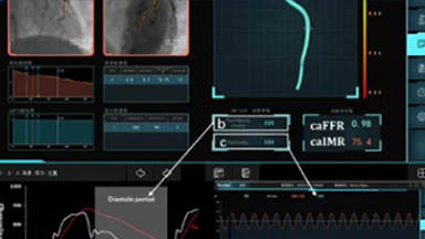 冠狀動脈血流儲備分數(shù)測量系統(tǒng)（蘇州潤邁德）