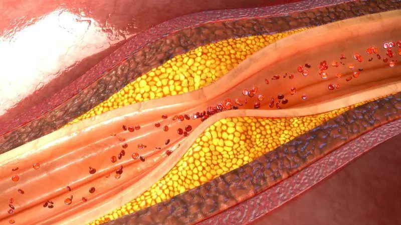 風口 | 冠脈鈣化&ldquo;終結者&rdquo;&mdash;&mdash;血管內沖擊波